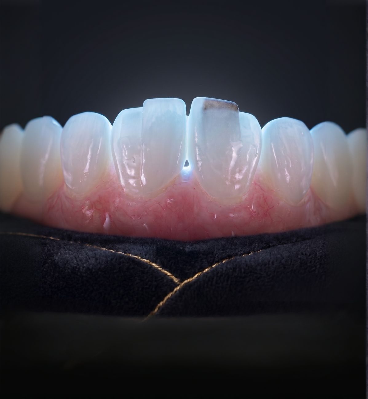 Porcelain veneer close-up showing natural translucency